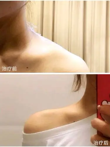 斜方肌发达,打了瘦肩针注射后,两个星期线条立即展现_圈子-新氧美容整