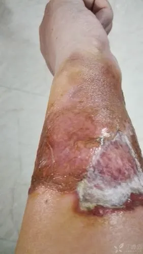 面汤烫伤右前臂,第19天了,啥时候新皮能长全?