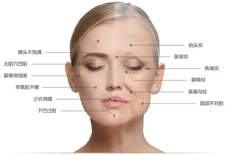 面部自体脂肪填充