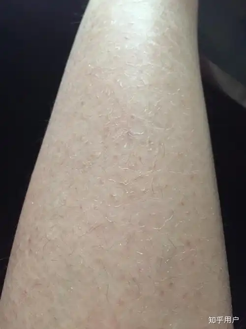 我从出生就有鱼鳞病遗传皮肤病治不好有些自卑怎么办