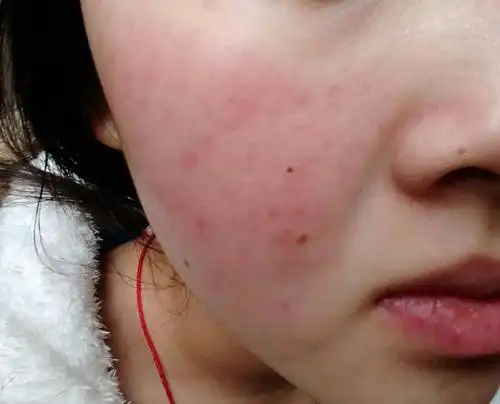 修复红血丝用什么好,敏感肌红血丝皮肤好难处理!