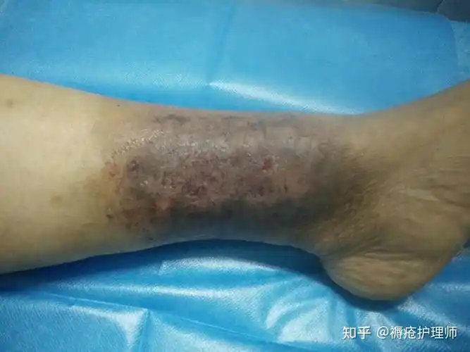 糖尿病足坏疽怎么治疗和护理糖尿病脚刚开始的图片有哪些