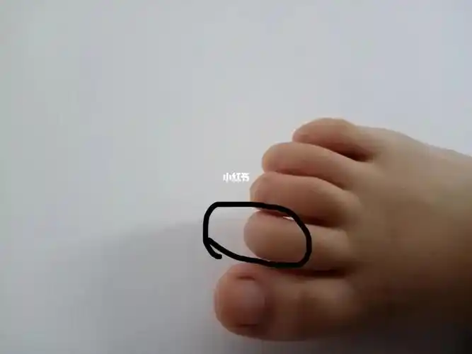 第二个脚趾伸不值