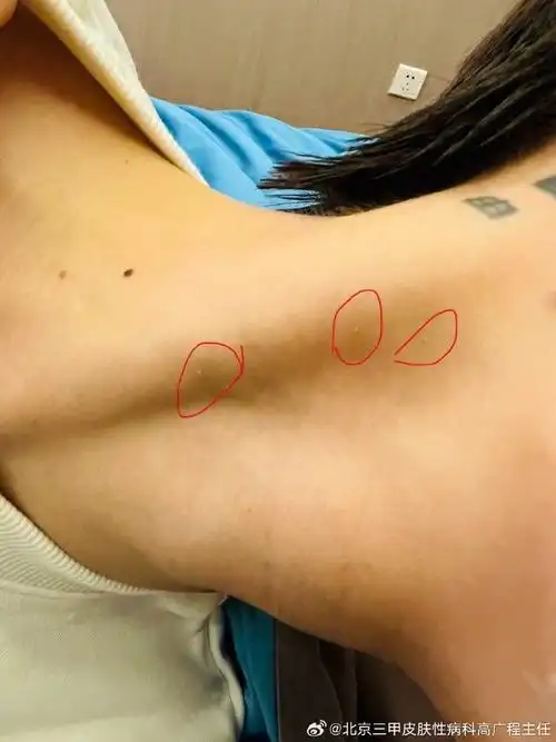 女,28岁,脖子上增生物居多,肚子上一个.有一些小肉揪的东西.