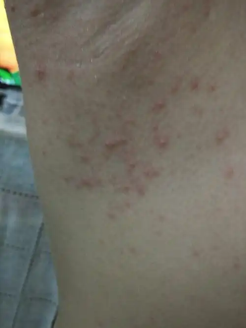 宝宝游水回来后全身长红疹?