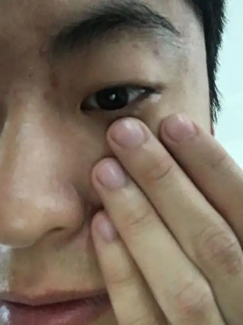 眼皮内侧长了个小疙瘩是咋回事啊 大神们