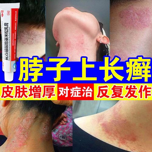 脖子上长癣】脖子痒起红疙瘩药膏神经性皮炎专用药牛皮癣止痒软膏复方