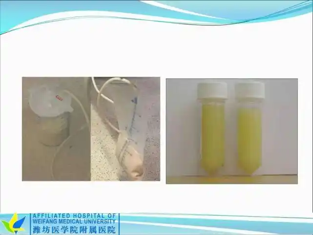 课件李莎莎一例乳糜漏合并2型糖尿病患者营养治疗