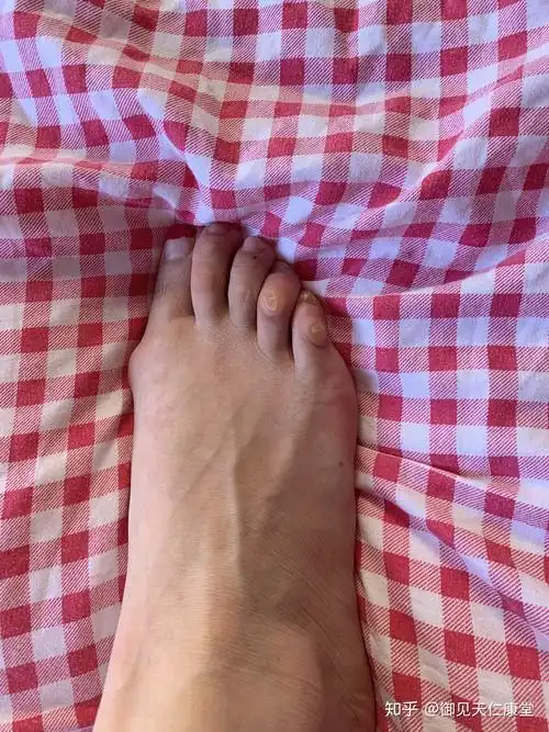 经常穿比较紧鞋面低的鞋子,很容易把脚趾关节部位也磨出老茧,而且这个