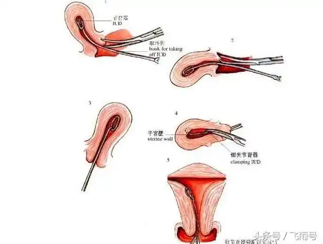 上环真的好吗这些危害对身体也太大了