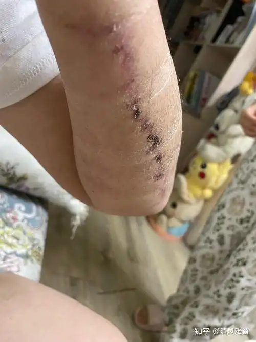 20厘米纹身切除及恢复日记3