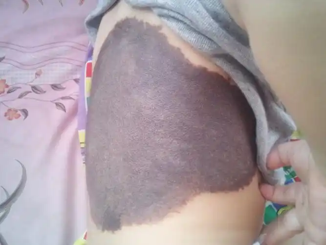 所患疾病:巨大黑色素毛痣