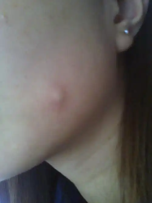 脸上长了个粉瘤,有1cm大小,半年时间了,不动手术,怎样去除?