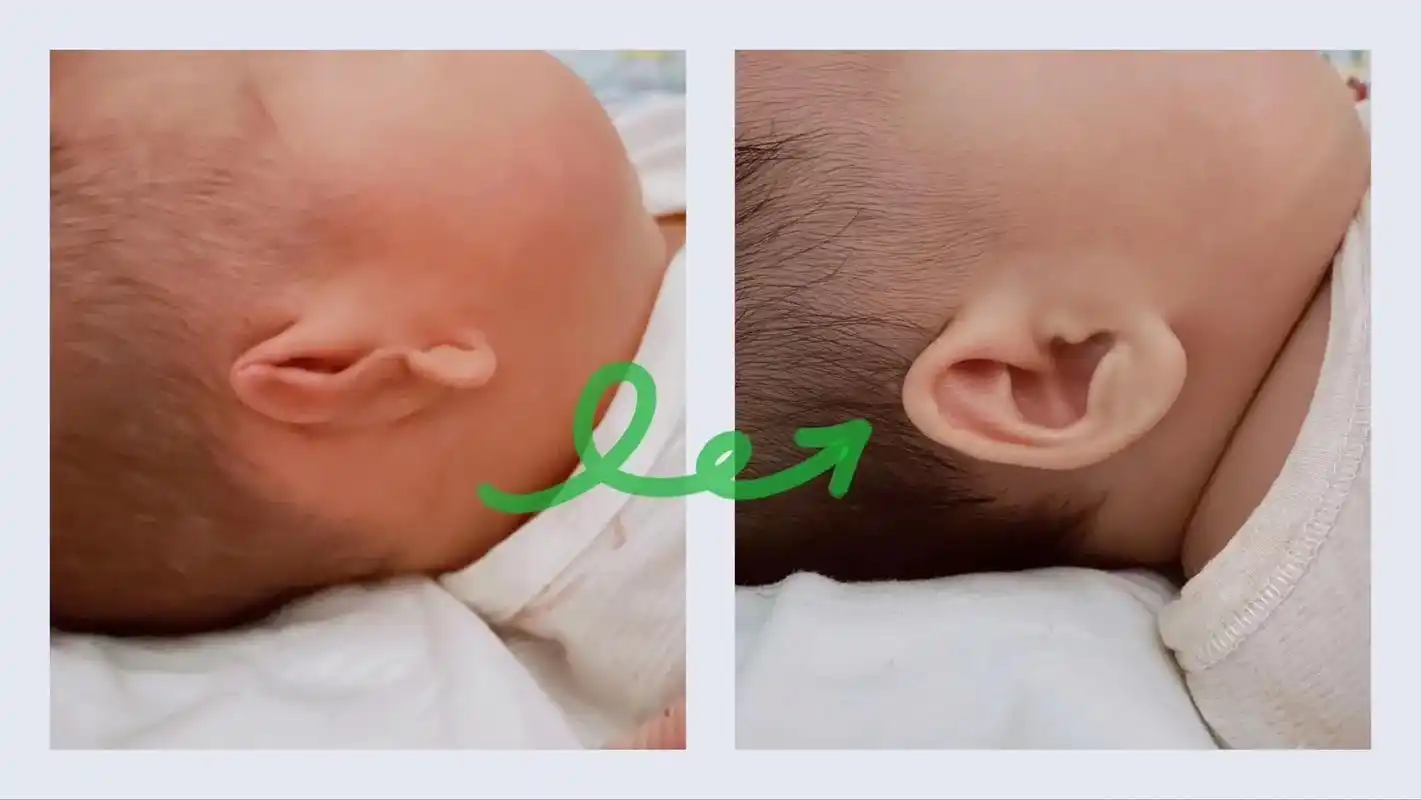 因早产在保温箱里呆了两周,回到家耳朵耳廓 - 抖音