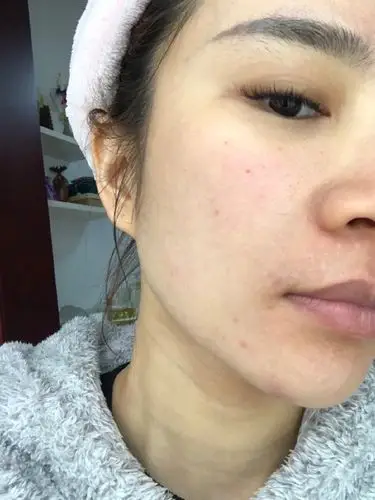 先说肤质:本人严格来说是混合肌肤,但是以前年轻不懂_圈子-新氧美容