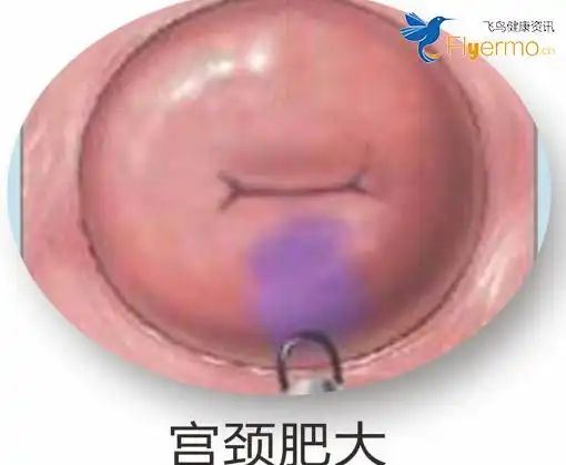 宫颈肥大的三大主要危害