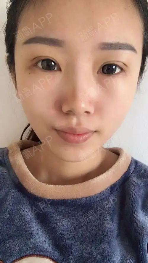 之前我还以为手术要肿得天昏地暗,居然不肿,才几天双眼皮就已经恢复