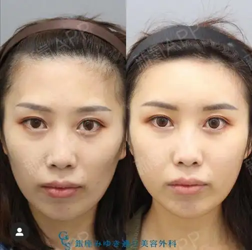 今天为大家介绍的是在额头,太阳穴,脸颊下方进行【高浓缩脂肪填充】的