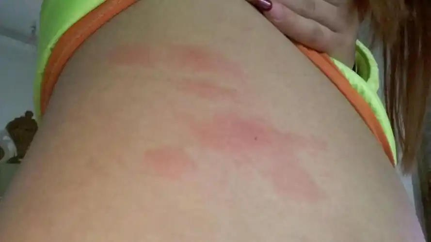 有没有肚皮起痒疙瘩的?