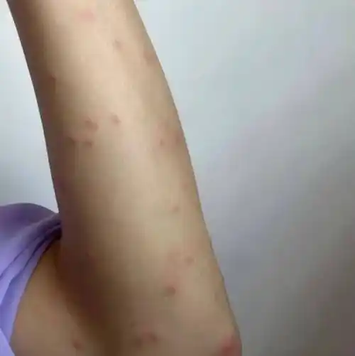 一觉醒来,身上密密麻麻…近期高发,很多人都中招了!先从家里检查