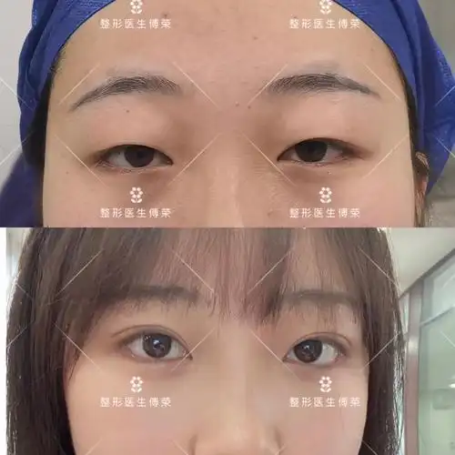 成都双眼皮傅荣医生全切双眼皮肿泡眼案例_眼部整形 - 好大夫在线