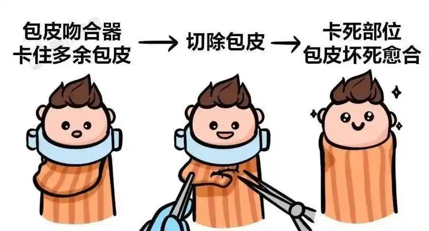 包皮手术方式怎么选择?