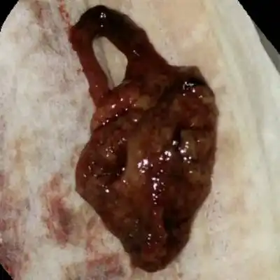 这个是我今天早上,上厕所掉出来的,是不是我的胎儿已经掉了