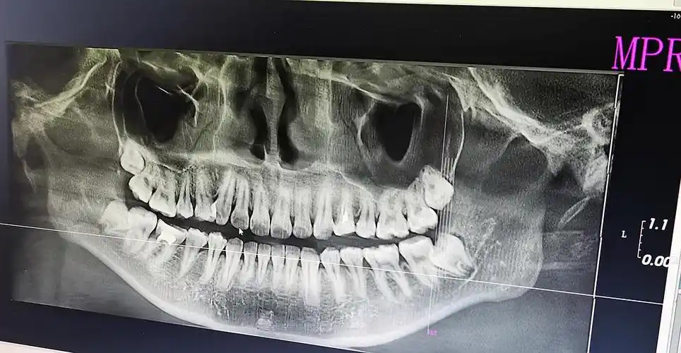 请大家帮忙看看下面智齿需不需要拔.