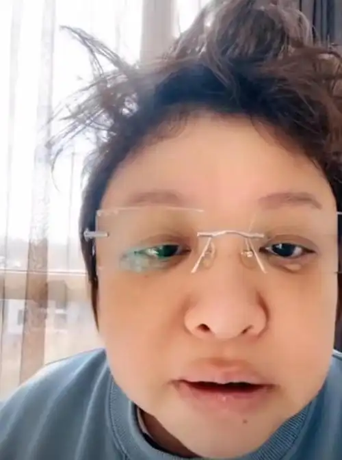 51岁韩红感染第三天暴瘦脸小了一圈整个人憔悴不堪