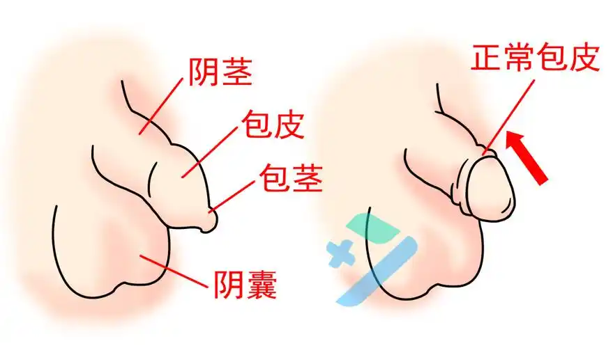 男娃包茎,包皮过长,不及时处理,真的很危险!_龟头_割包皮_阴茎