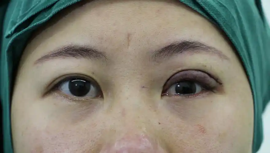 单眼上睑下垂修复第12天,小姑娘开心地说"特别满意感谢医生"