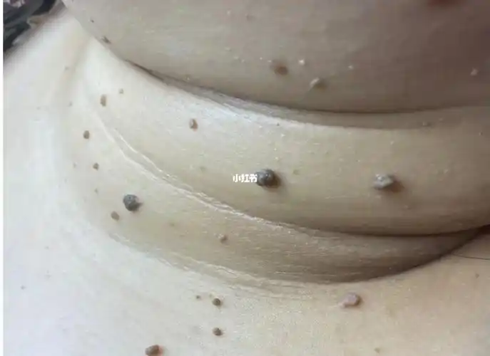 摸摸你的脖子有吗? 👉🏻丝状疣 1,湿寒过重,淋巴不畅,经络不通._