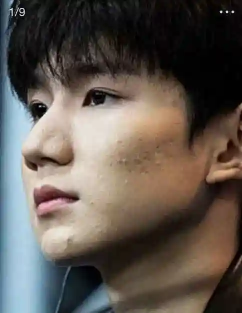 王源痘坑是拍戏效果导演说出真相后网友再也不黑你