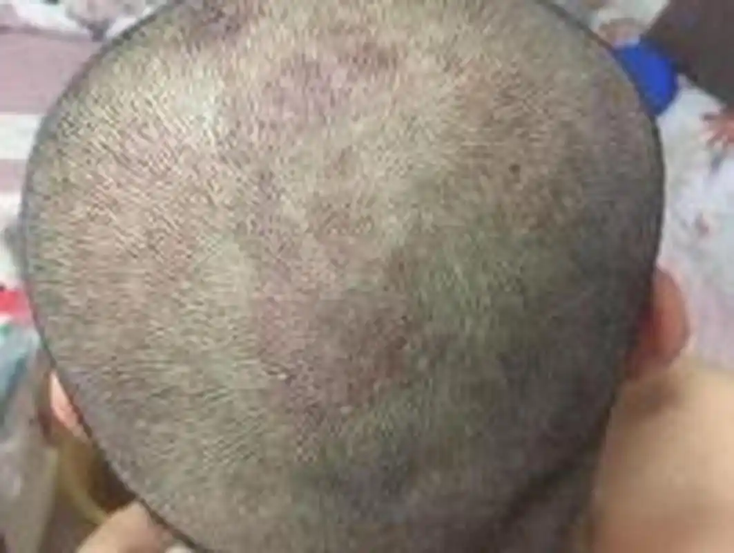 头皮银屑病用什么洗发水比较好?