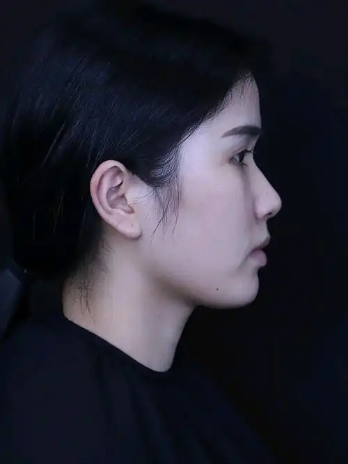 【术前】我鼻梁不是很塌的那种,就是侧面看山根很低,_圈子-新氧美容