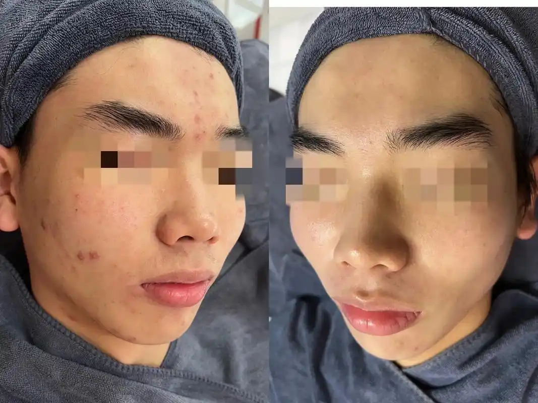 18岁小哥哥祛痘5个月左右皮肤前后对比效果图