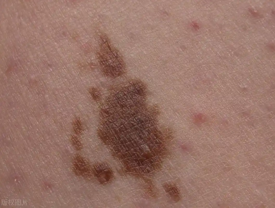 小腿上出现斑,可能是糖尿病,提醒:不想有并发症,做好4件事