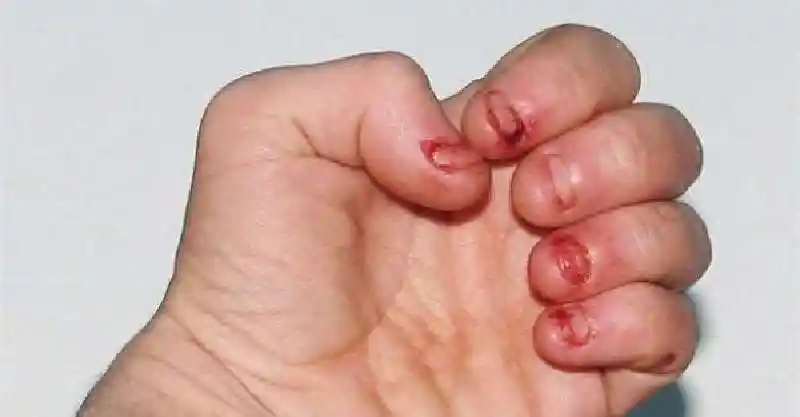 每当他一紧张总会啃咬指甲,不料这个看似没什麼的坏习惯竟然引发严重