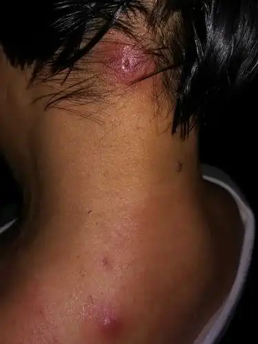 血毒/皮肤病/脓疮