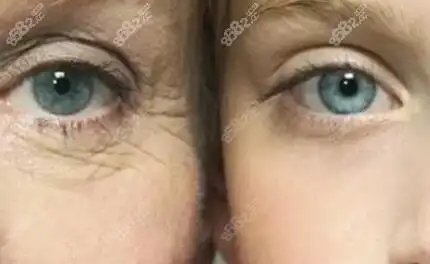 眼部细纹多怎么有效去除?眼周小熨斗—热玛吉帮你来搞定