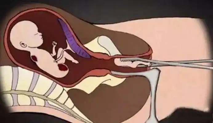 大月份早孕钳夹手术中孕是指妊娠时间在14至28周以内,中孕引产根据