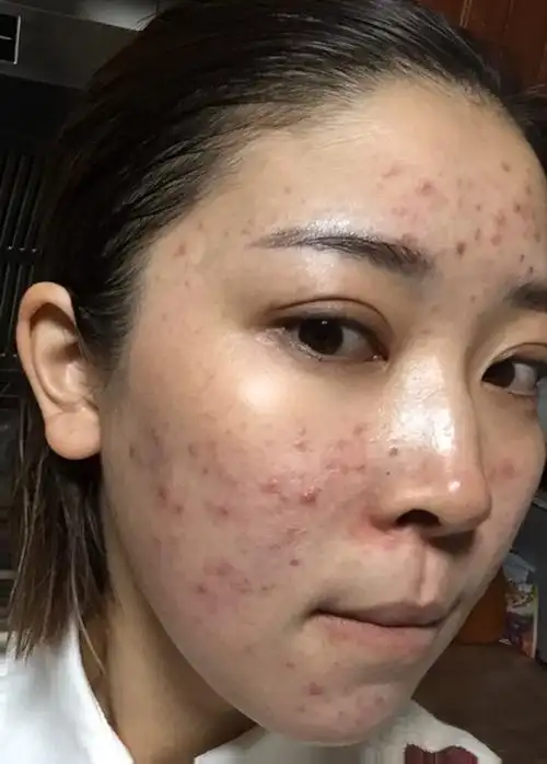 脱皮后多久恢复新皮