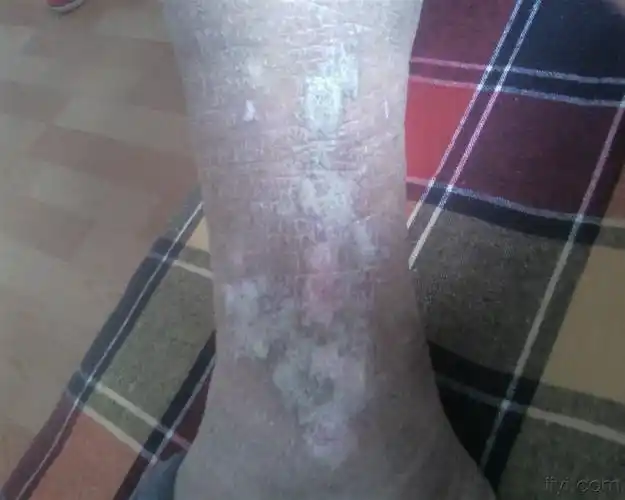 湿疹,神经性皮炎,过敏性皮炎,老年瘙痒症的 诊断和治疗 - 皮肤及性传