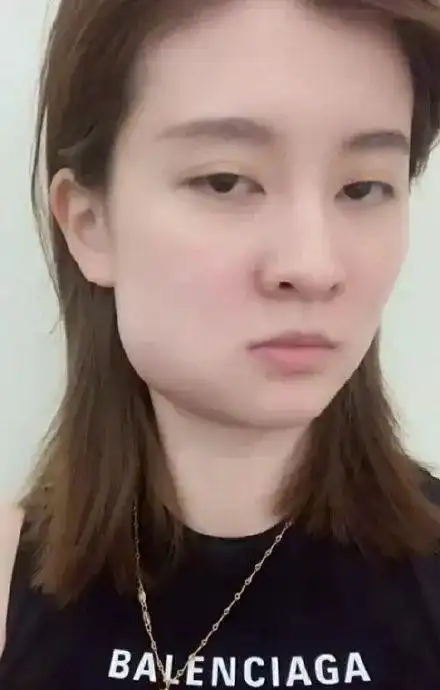 明星拔完智齿脸竟变成这样到底该不该拔