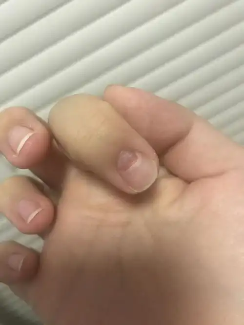 手指甲从甲根qiao