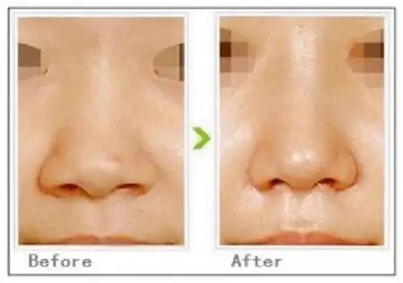 鼻孔缩小手术适应人群,方法和对比图