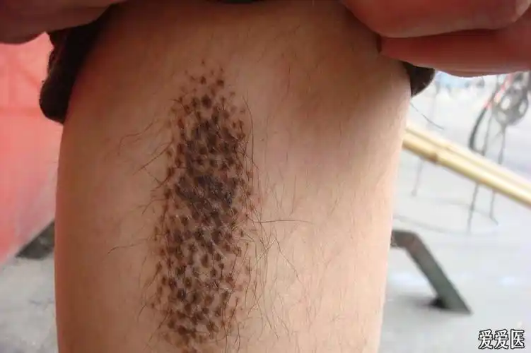 看图诊断33色素性毛表皮痣
