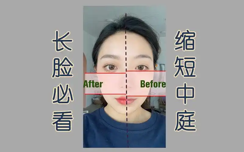 长脸变短脸神奇中庭缩短术