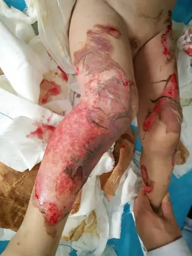 关注留守儿童,警惕意外发生——十院烧伤患儿治疗追踪