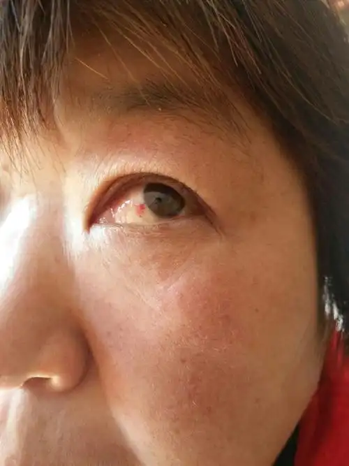 老妈眼睛发红什么问题